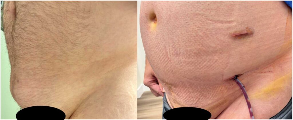 Before and after abdominal wall reconstruction surgery
