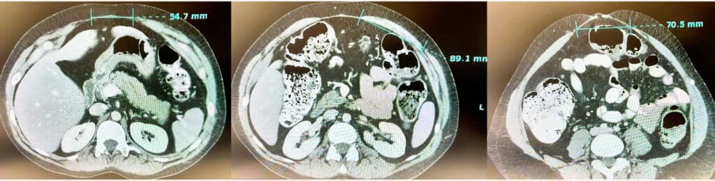 CT analysis of an abdominal wall