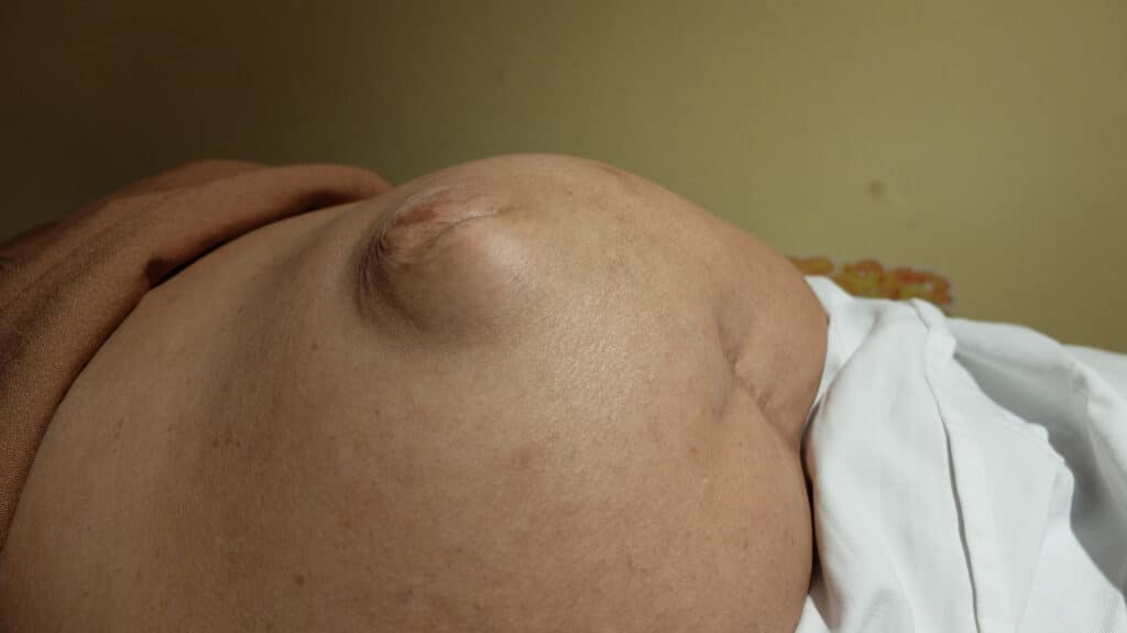 A complex abdominal wall hernia