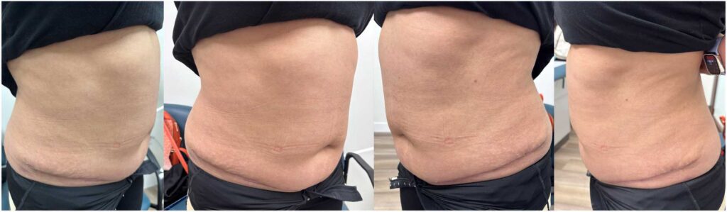 Patient photos from after panniculectomy surgery