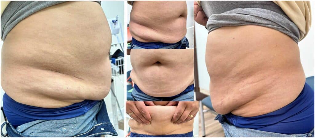 Patient photos from before panniculectomy surgery
