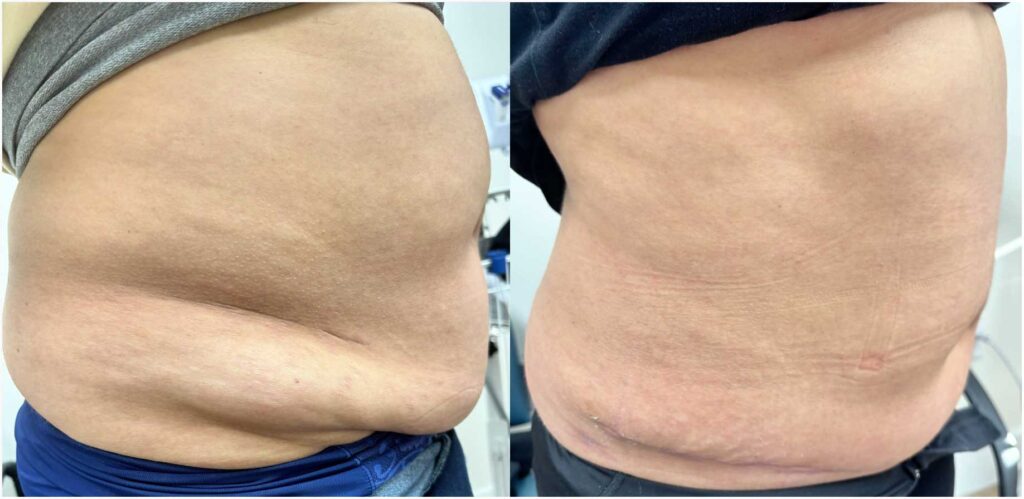 Patient before and after panniculectomy