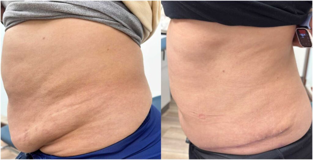 Pre and post panniculectomy