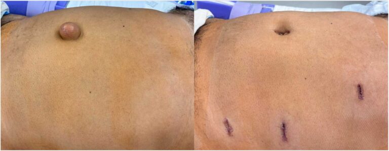 Patient before and after ventral hernia repair
