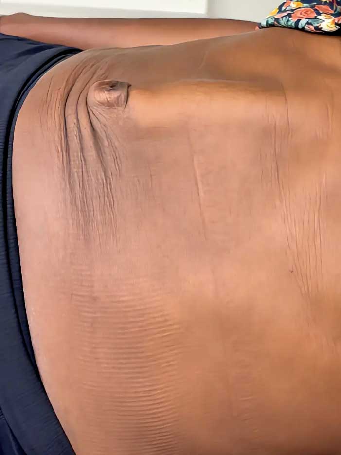 Patient with ventral hernia and diastasis recti
