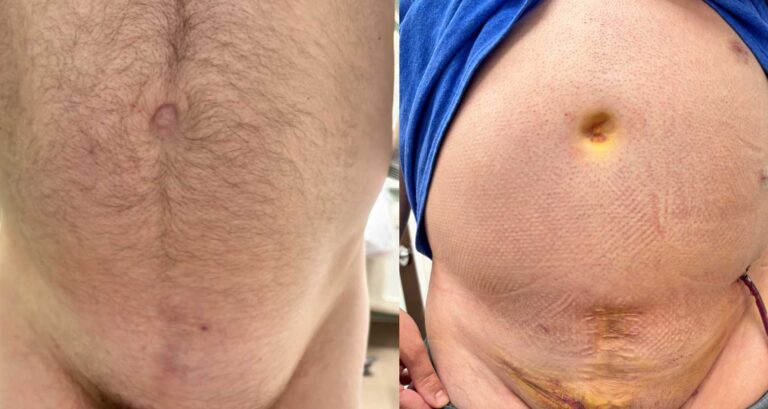 Patient before and after hernia repair