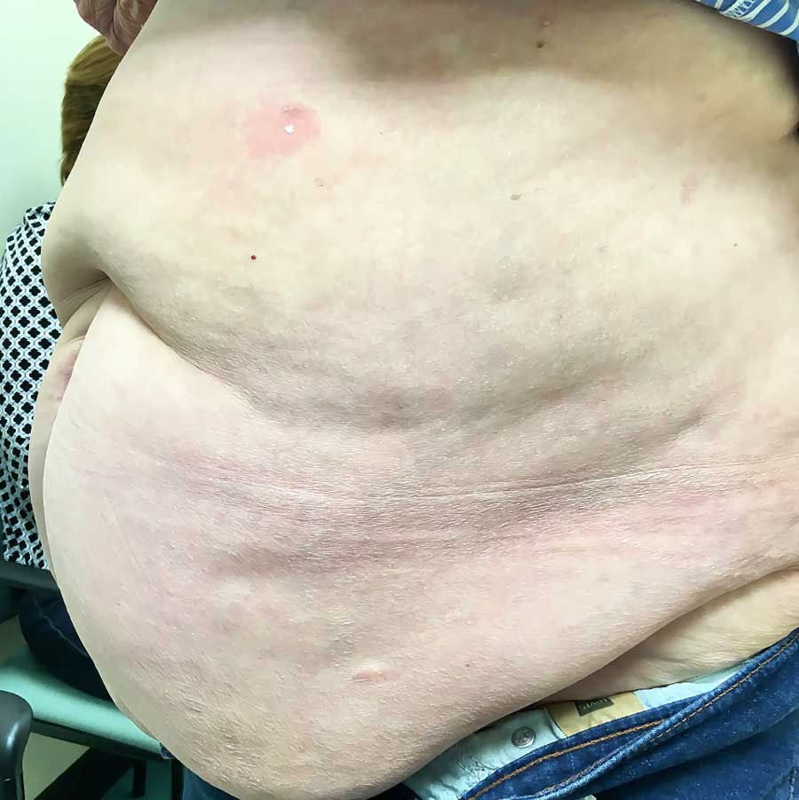 Side view of a patient with a complex hernia