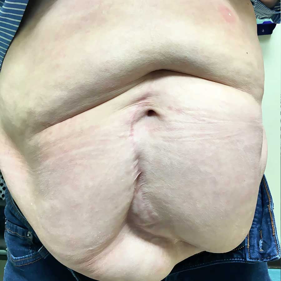 Front view of a patient with a complex hernia