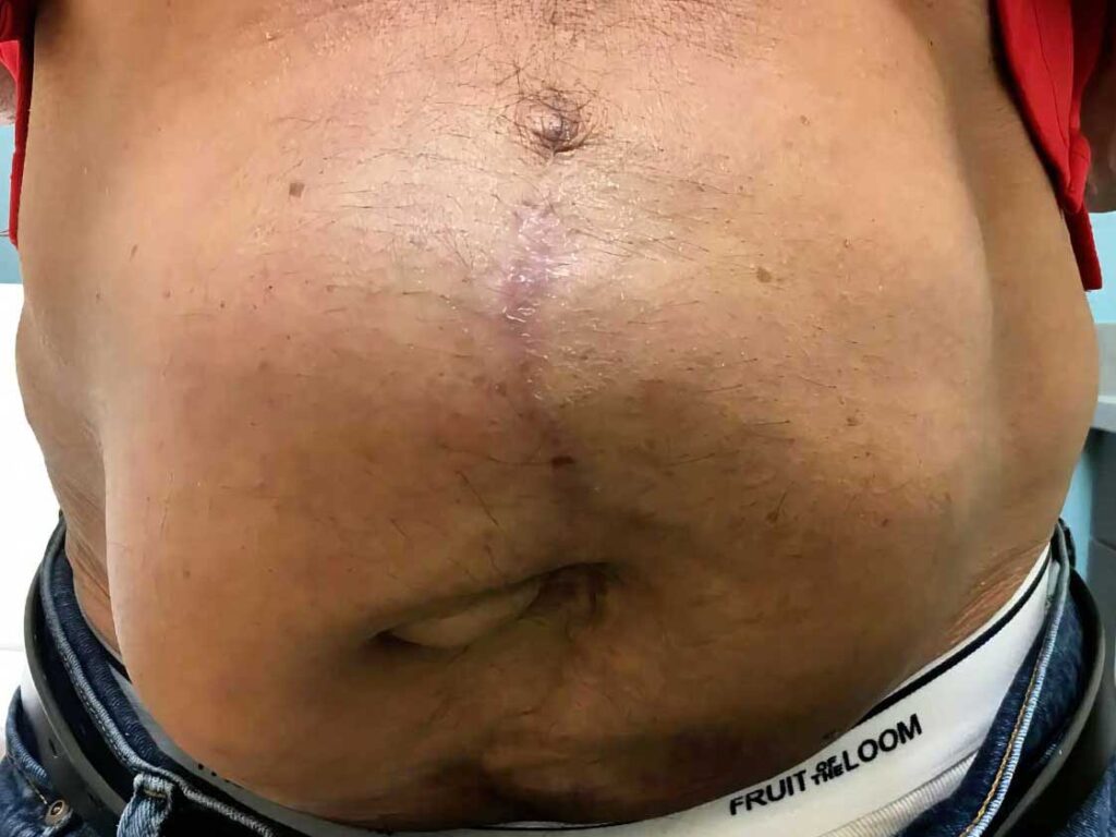 Front view of a patient in need of a complex abdominal wall reconstruction