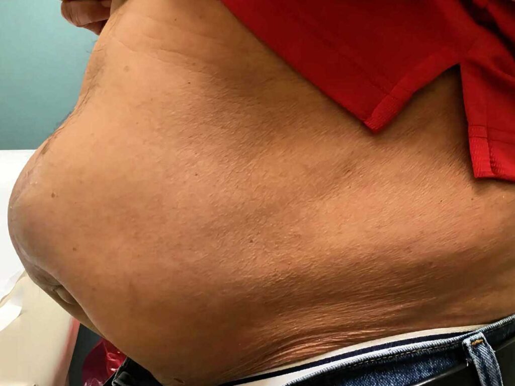 Side view of a patient in need of a complex abdominal wall reconstruction