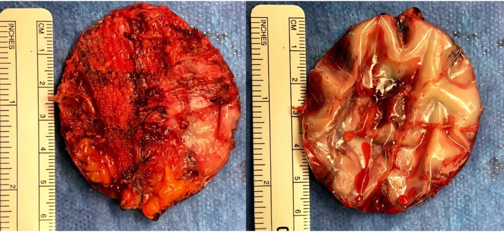 Excised (removed) mesh from a prior hernia surgery