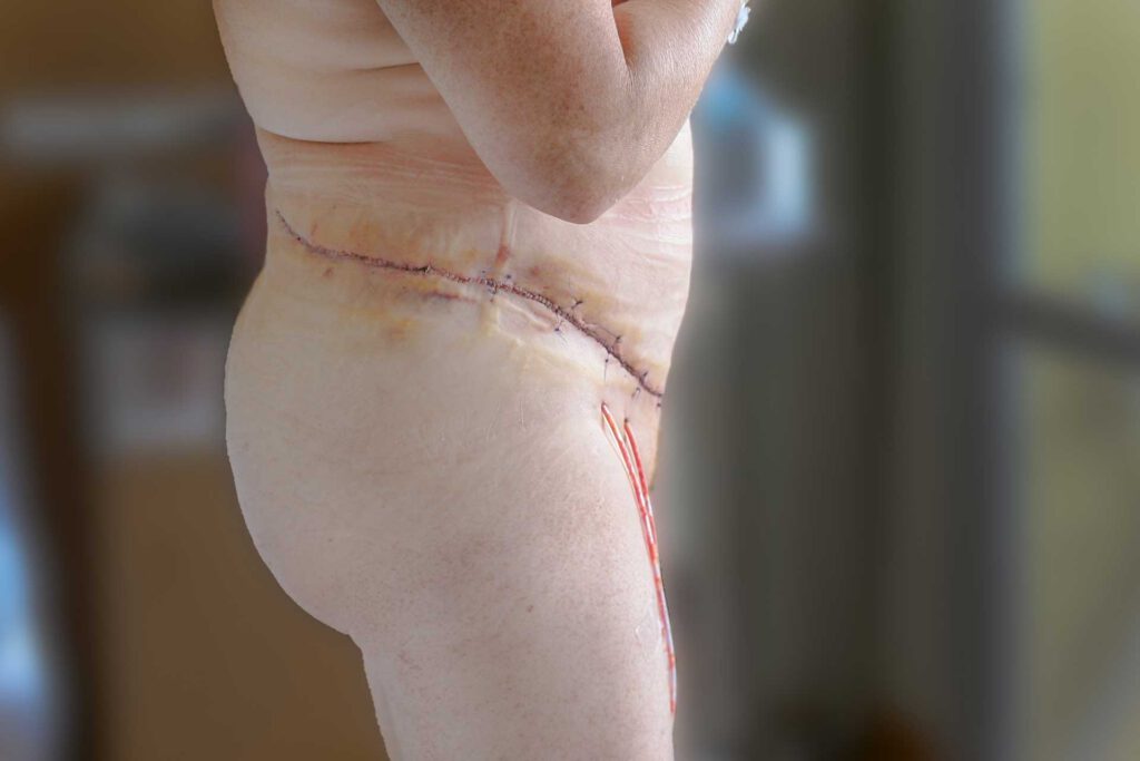 Panniculectomy patient after surgery