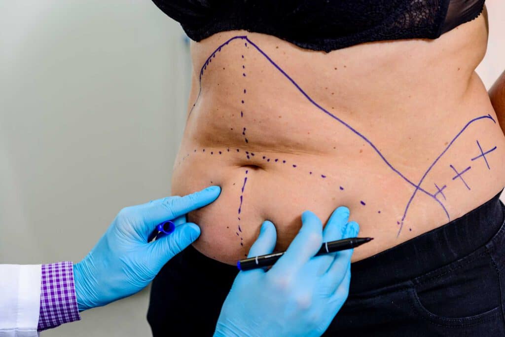 Tummy tuck patient prior to surgery