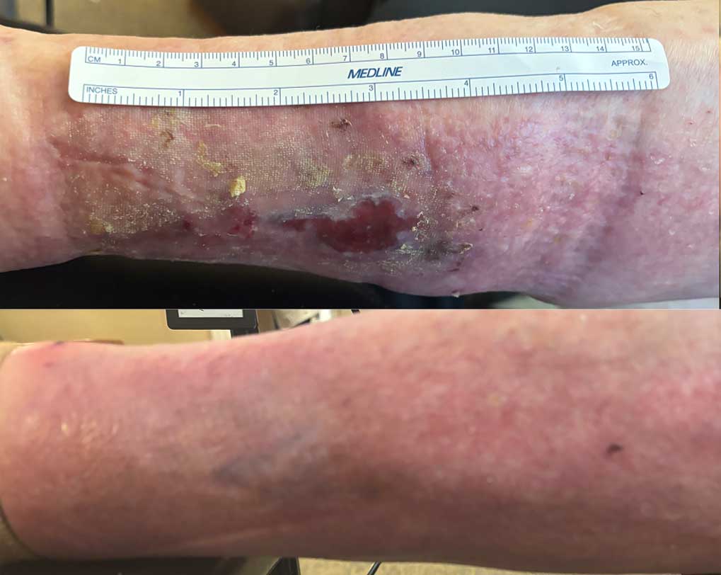 Comprehensive wound care progress